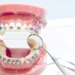 Dental model showing colorful braces on upper and lower teeth with orthodontic instruments for interceptive treatment planni.