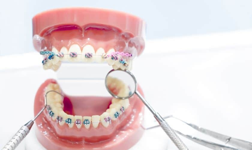 Dental model showing colorful braces on upper and lower teeth with orthodontic instruments for interceptive treatment planni.