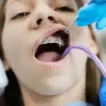 Child patient with metal braces receiving orthodontic examination with dental tools.