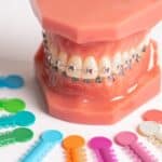 Dental model displaying metal braces with colorful orthodontic ligatures and cleaning tools.