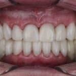 Close-up of aligned white teeth showing results of restorative dental treatment in Spring, TX.