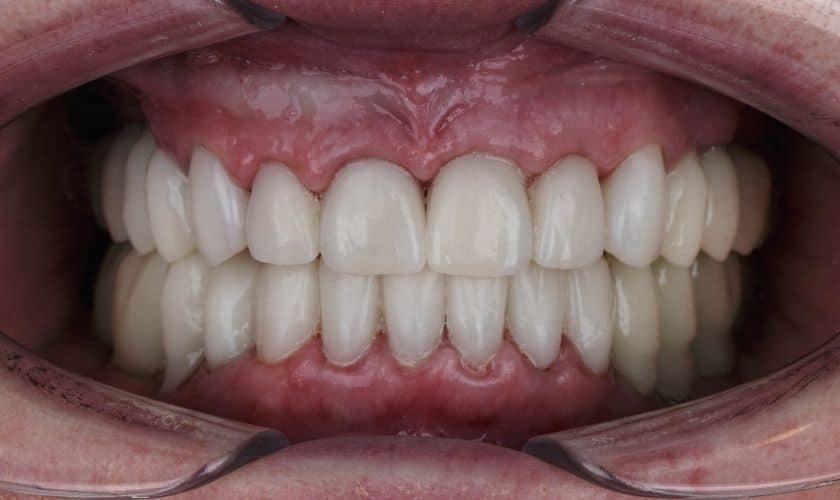 Close-up of aligned white teeth showing results of restorative dental treatment in Spring, TX.