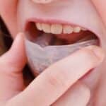 Child inserting clear orthodontic aligner into mouth for SureSmile treatment.