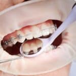 Orthodontist examining child's braces during dental treatment to improve smile and confidence.