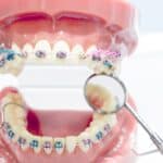 Dental model showing upper and lower teeth with colorful orthodontic braces and brackets.