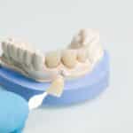 Dental crown shade guide showing tooth-colored porcelain crowns on a model for patient comparison.
