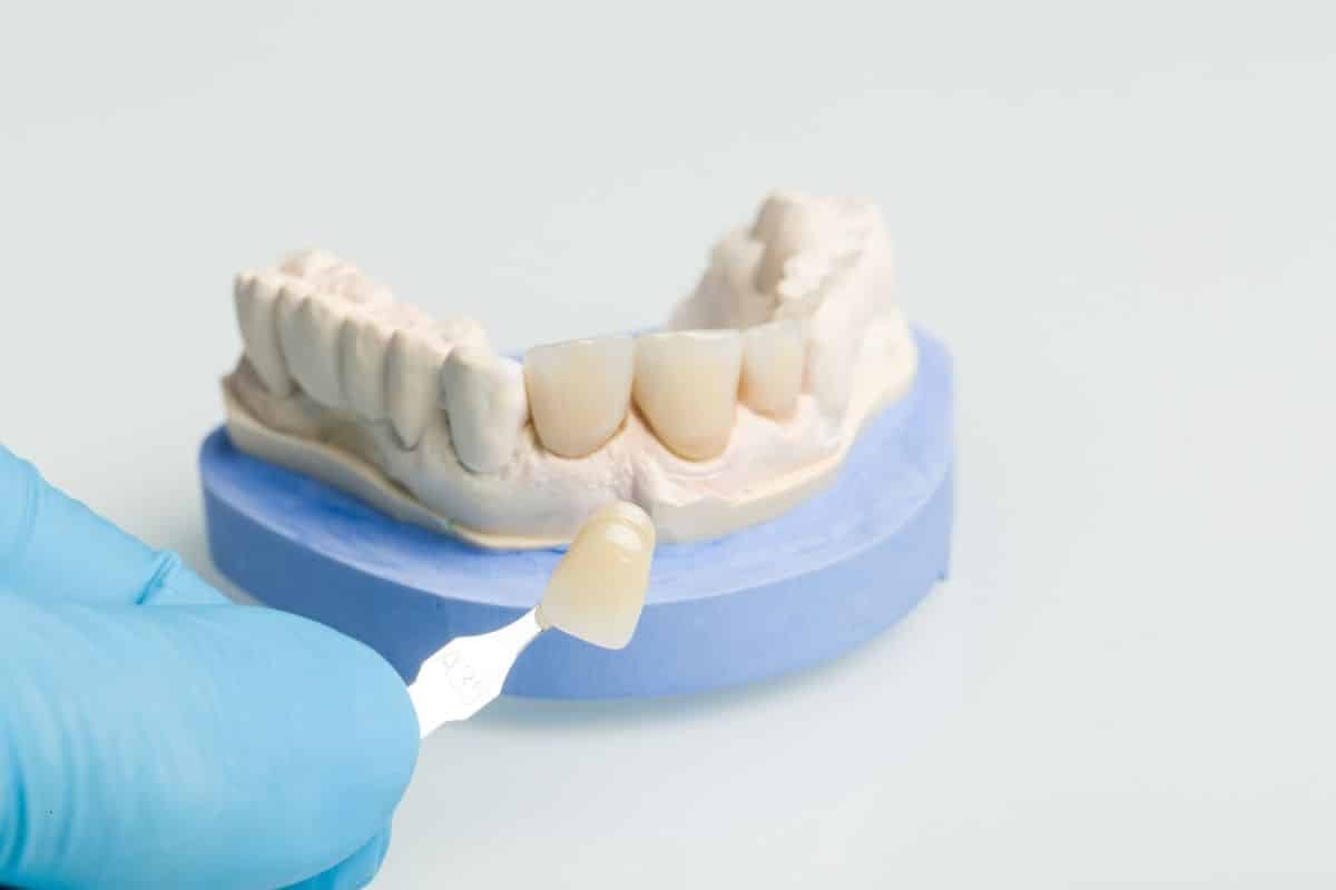 Dental crown shade guide showing tooth-colored porcelain crowns on a model for patient comparison.
