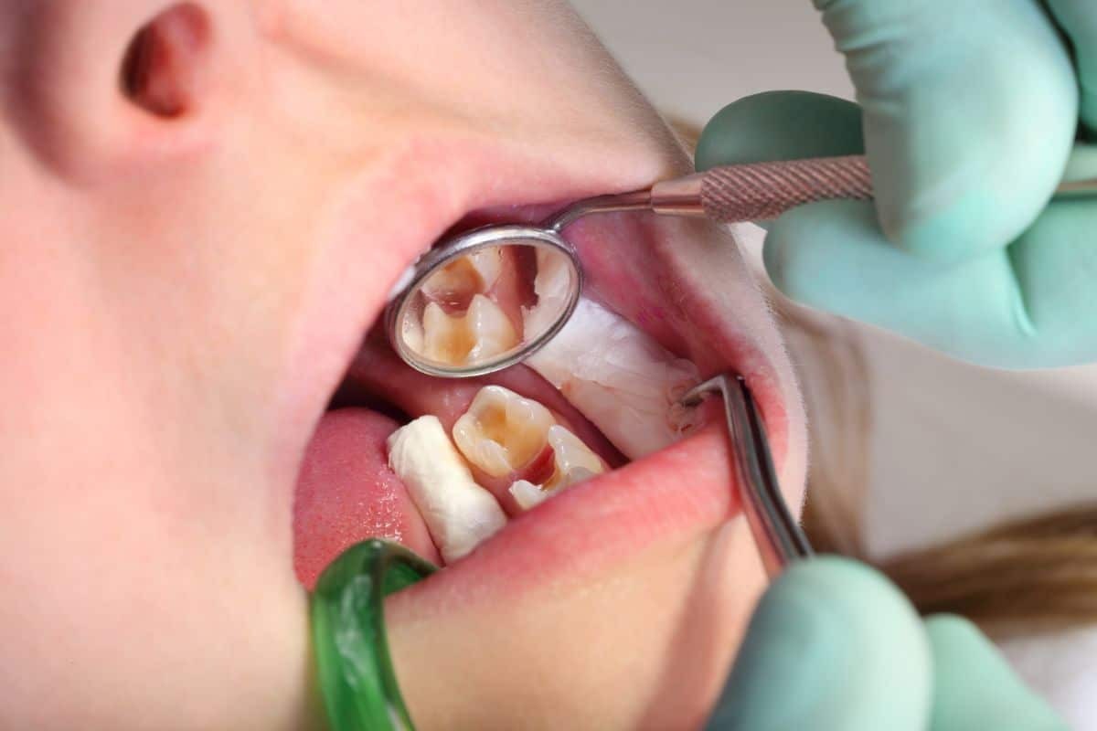 Pediatric dental exam showing child's teeth with cavities during intraoral inspection.