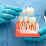 Dental implant model showing tooth crown placement on jawbone with natural teeth above, held by dentist in blue gloves.