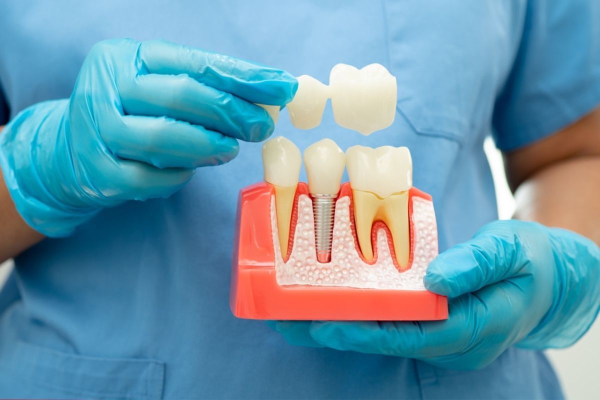 Dental implant model showing tooth crown placement on jawbone with natural teeth above, held by dentist in blue gloves.