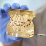 Dental model showing colorful braces on teeth for Phase 1 orthodontic treatment planning.