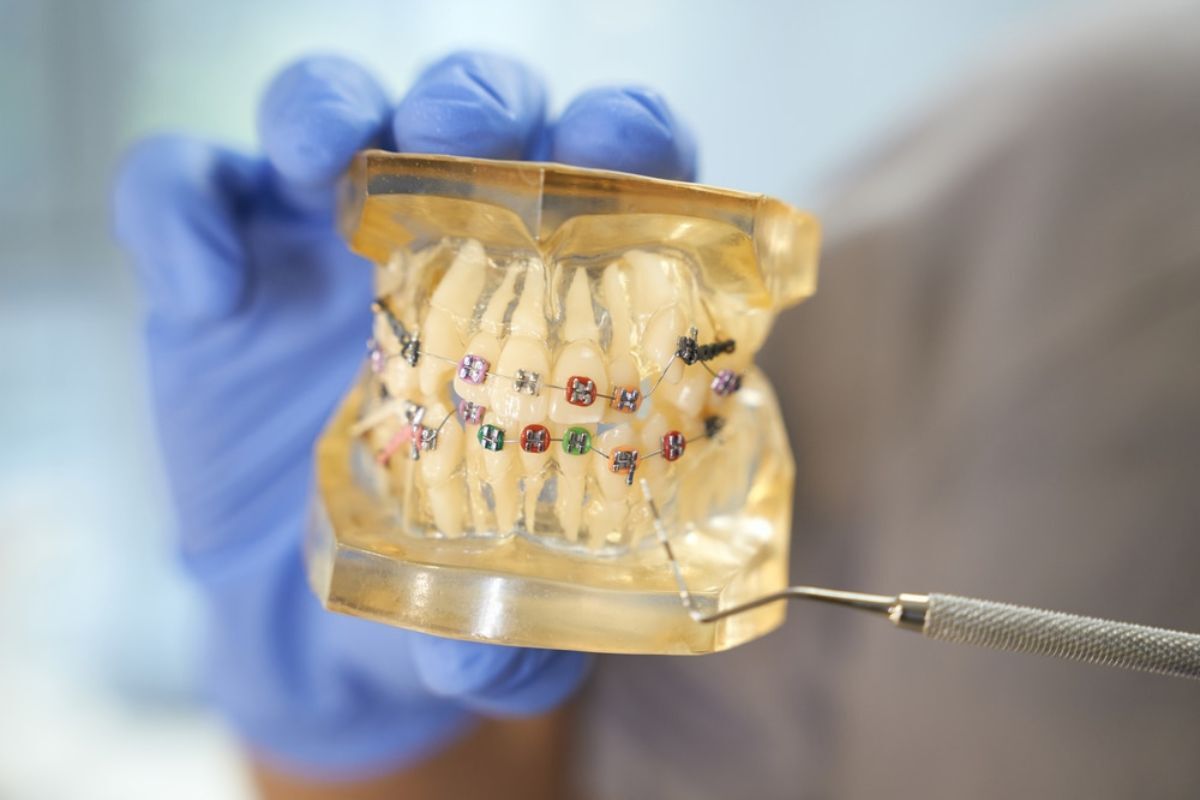 Dental model showing colorful braces on teeth for Phase 1 orthodontic treatment planning.