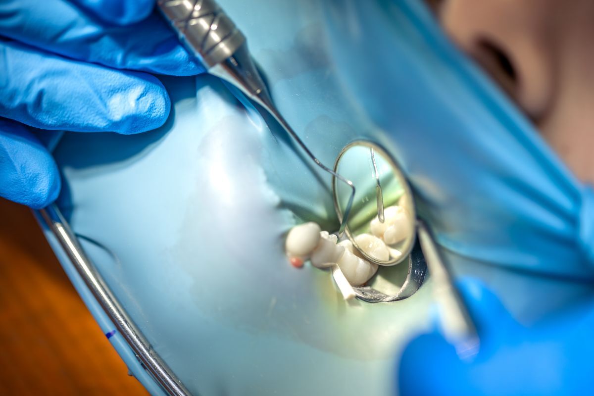 Dentist examining tooth cavity with dental mirror and explorer tool during examination.