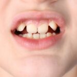 Child's smile showing upper front teeth with spacing and misalignment typical of malocclusion.