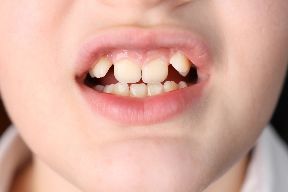 Child's smile showing upper front teeth with spacing and misalignment typical of malocclusion.