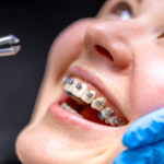 Close-up of patient's teeth with metal braces during dental examination with mirror.