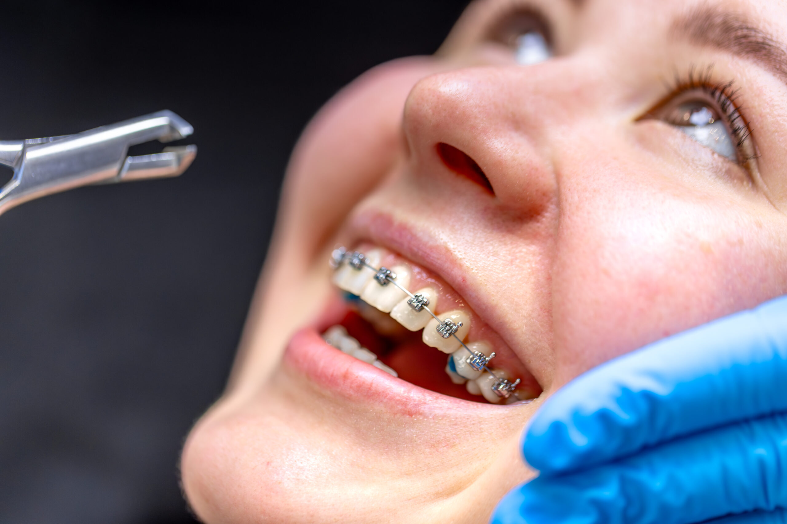 Close-up of patient's teeth with metal braces during dental examination with mirror.