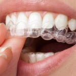 Close-up of clear Invisalign aligners being inserted over white upper teeth during treatment.