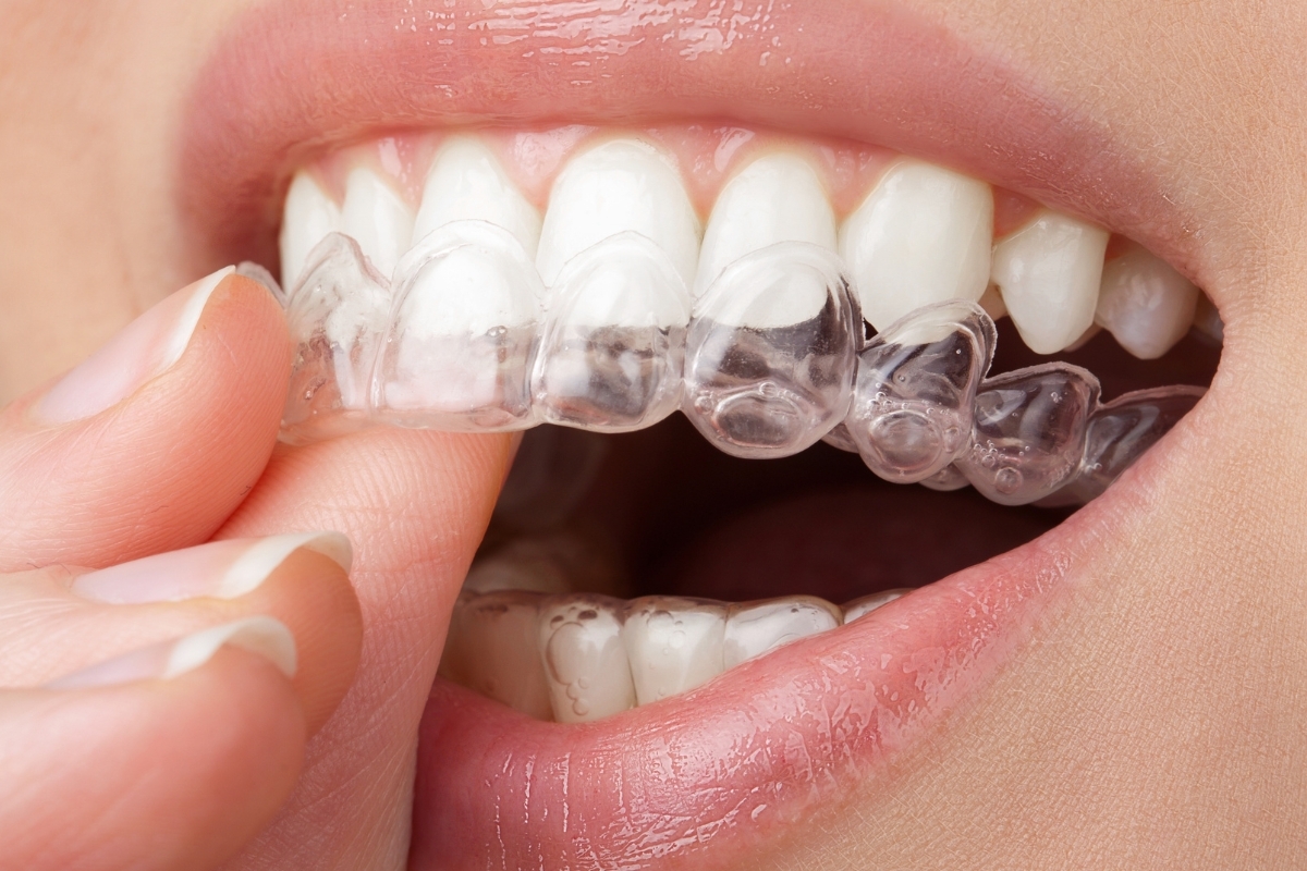 Close-up of clear Invisalign aligners being inserted over white upper teeth during treatment.