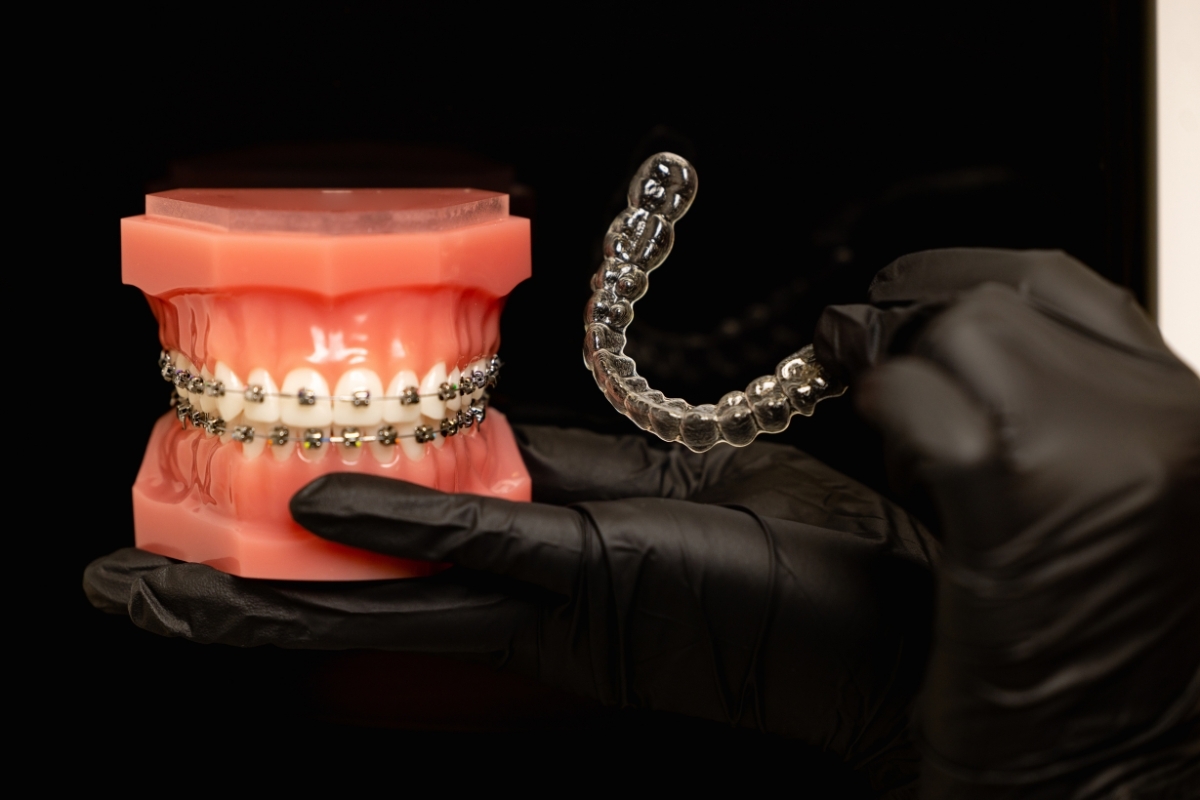 Orthodontic model showing metal braces and clear aligner treatment options for Spring patients.
