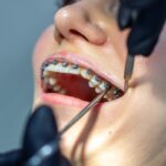 Close-up of metal braces on upper teeth during orthodontic examination and adjustment.