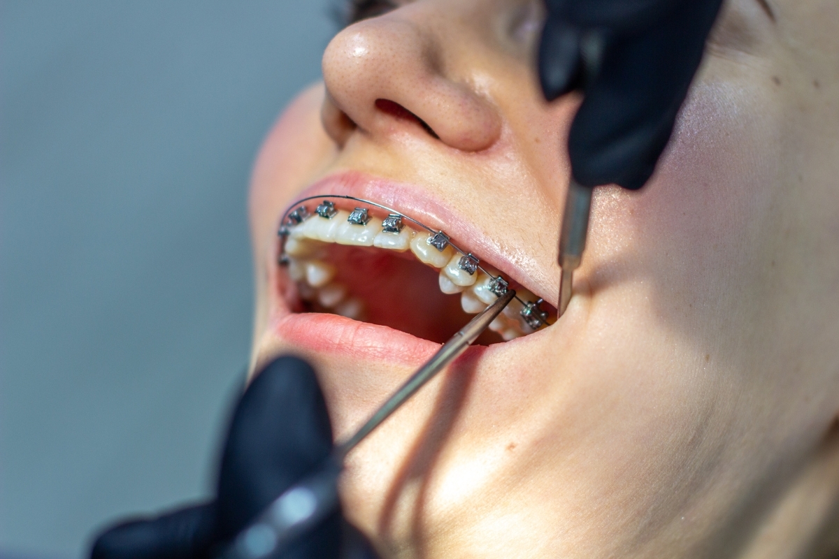 Close-up of metal braces on upper teeth during orthodontic examination and adjustment.