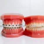 Dental models showing metal braces on upper teeth and natural tooth shade reference on lower teeth.
