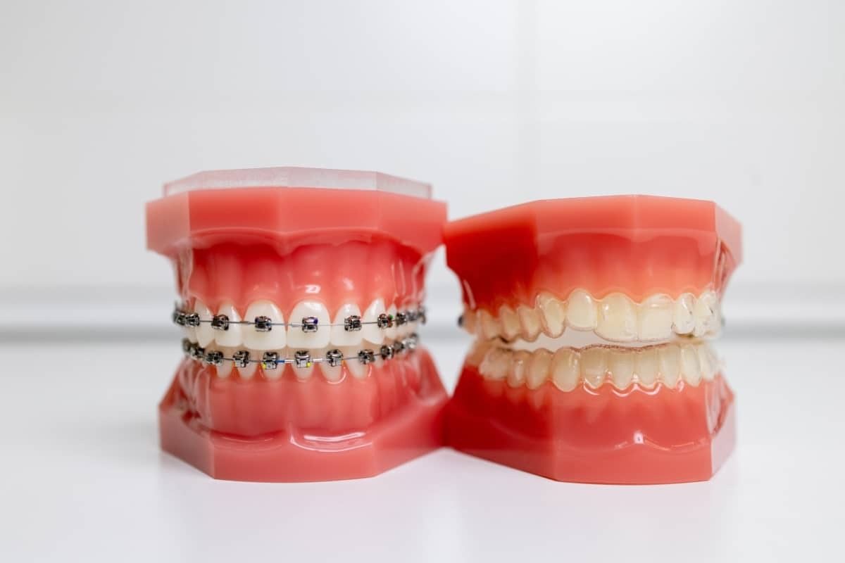 Dental models showing metal braces on upper teeth and natural tooth shade reference on lower teeth.